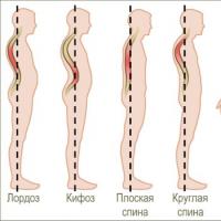 How to straighten your posture: causes of curvature, exercises, tips